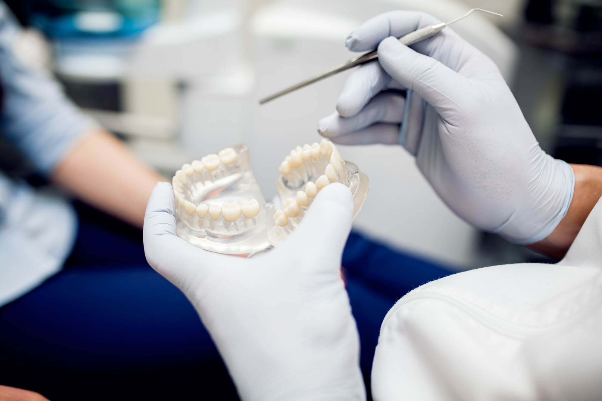Cuidados esenciales después de colocar un implante dental: guía completa para una recuperación adecuada