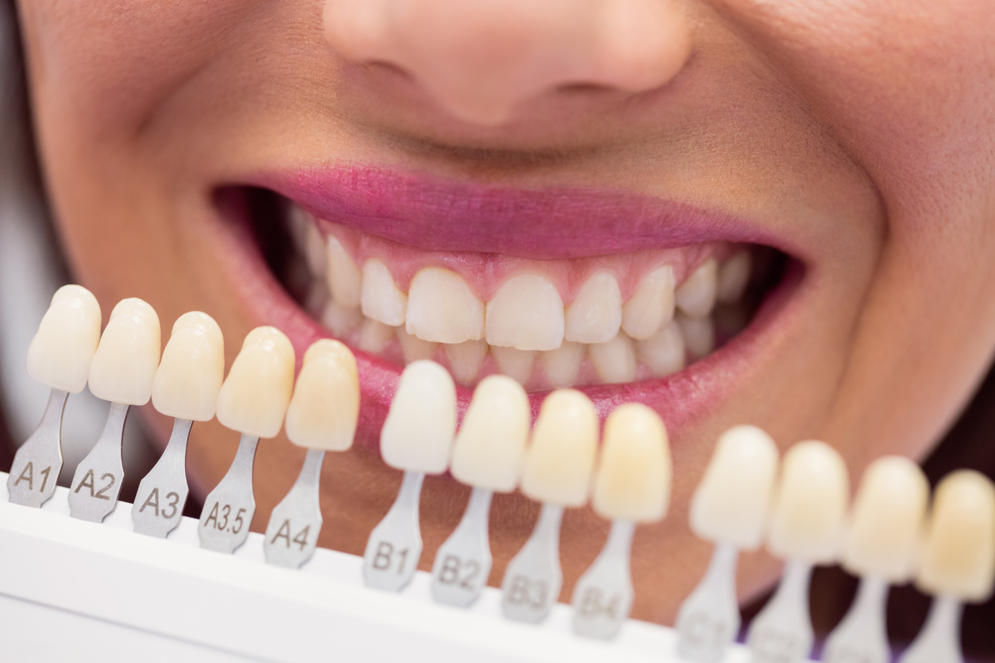 Carillas dentales: tipos, proceso y resultados que puedes esperar