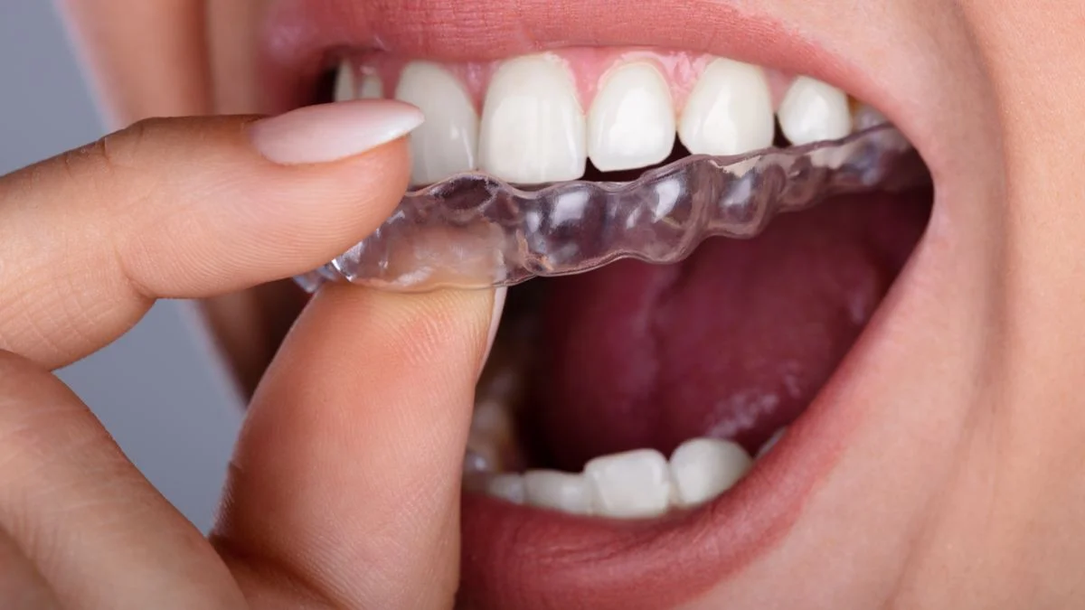 Protegido: Ortodoncia Invisible: La opción más estética para alinear tu sonrisa